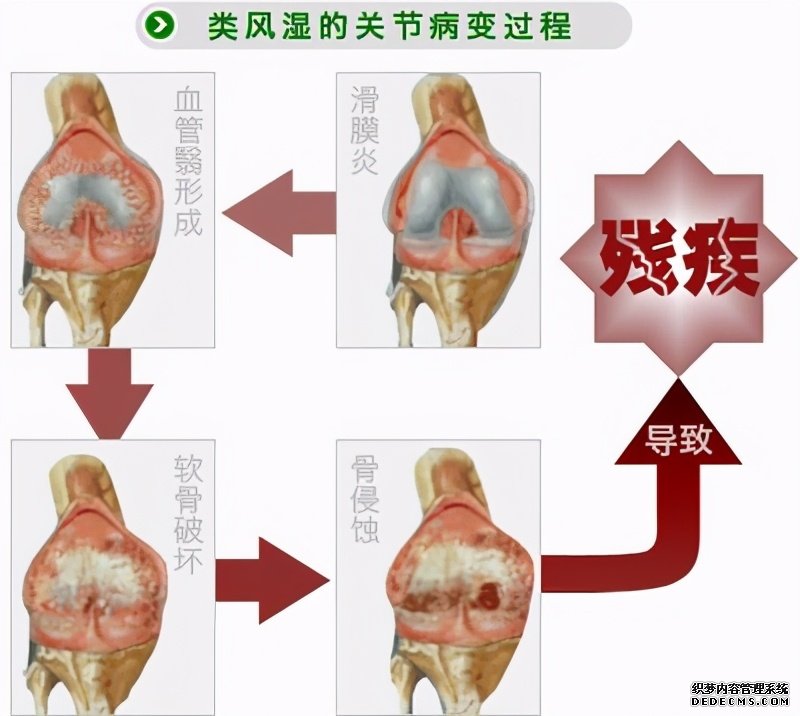 这些病症你中了几项？超过4项患类风湿性关节炎的几率极高