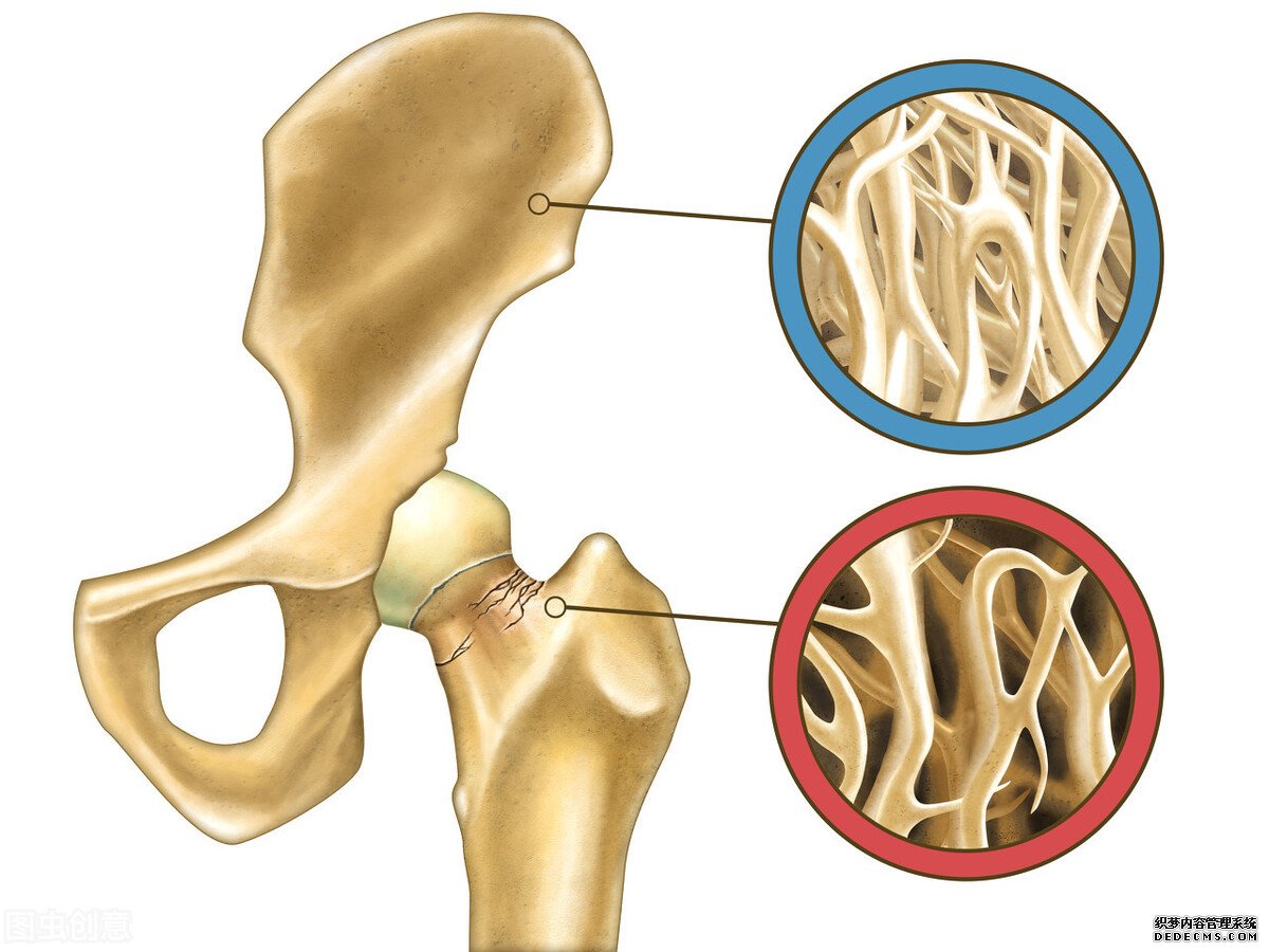 骨科医师直言：身体出现3种“异常”，骨质疏松找上门