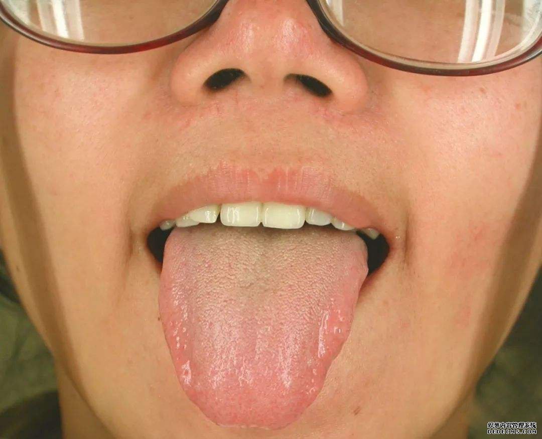 看舌头,知全身?自己是什么体质,体内是否有疾,伸舌一看便知